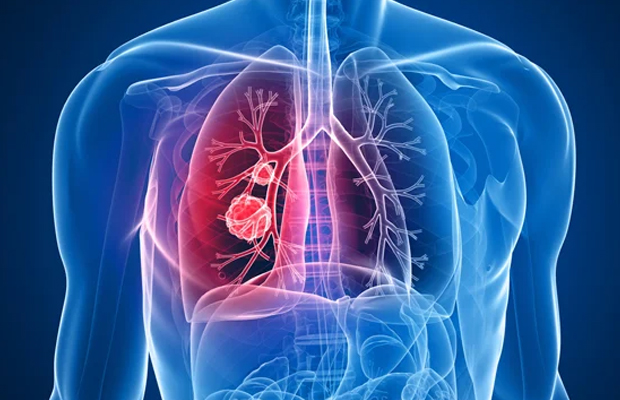 cáncer de pulmón 