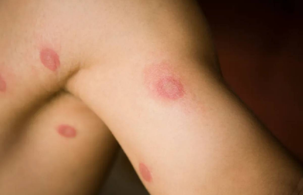 Minnesota experimenta brote de nueva infección fúngica de transmisión sexual | Televen