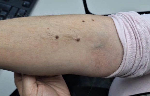 Conoce cómo diferenciar los lunares sanos de los melanomas